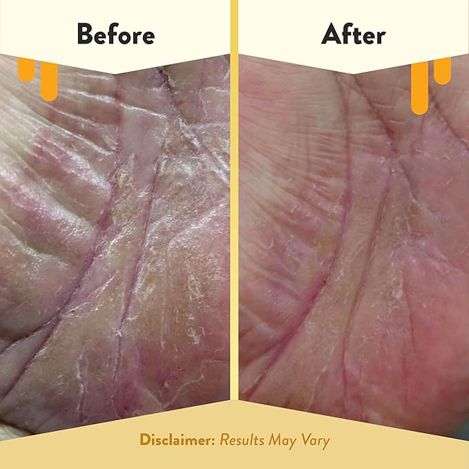 ECZEMA HONEY Brown Sugar Face & Body Scrub - Bath Scrub for Dry Skin - Natural & Gentle Face Scrub Soothes Eczema - Body Care Products for Women & Men - Sensitive Skin Exfoliating Body Scrub (6 Oz)