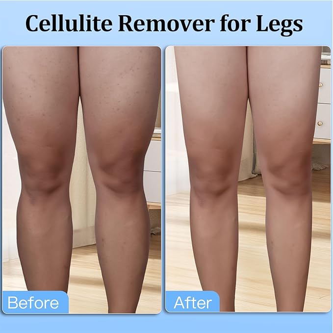 Cellulite Massage Roller, Cellulite Remover Tool for Thighs, Waist, Legs, Calf, Lymphatic Drainage, Fascia Massage, Anti-Celulitis, Body Sculpting, Relax Muscle Pain Relief Tool