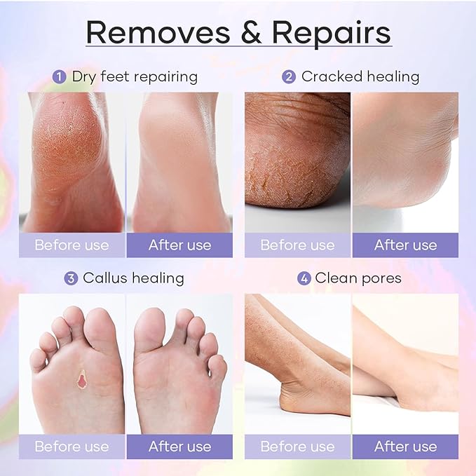 6-Step Foot Care System with Epsom Salt Soak, Callus Remover Gel, Sugar Scrub, Collagen Mask, Shea Butter Lotion, Massage Oil Candle + Disposable Pedicure Kit 5-1, Liner & Slippers. Orange 06 Set