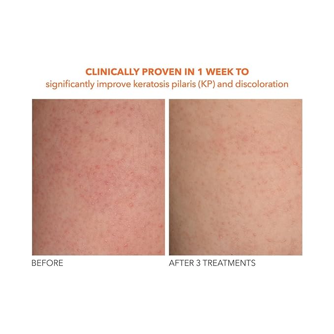 Dr. Dennis Gross Alpha Beta Exfoliating Body Treatment | Multi-Tasking Powered by AHA/BHAs for Smooth, Hydrated Skin While Improving Ingrown Hairs, Keratosis Pilaris, and Blemishes | 2 Textured Towels