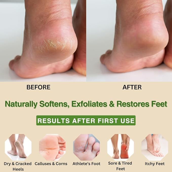 Natural Escapes Peppermint + Rosemary, Eucalyptus & Tea Tree Foot Cream for Dry Cracked Heels and Feet - Moisturizing Foot Lotion for Cracked Heel Repair - Callus Remover with Lactic Acid (4 oz)