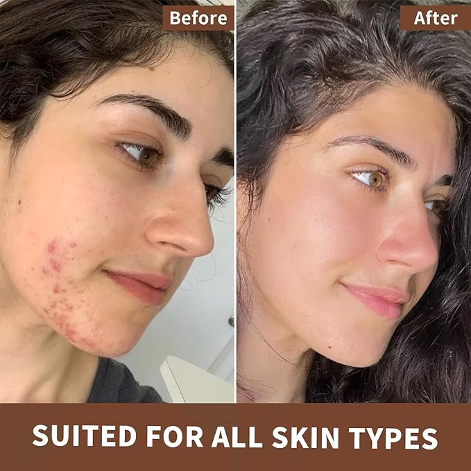 Flower Say USDA Organic Tea Tree Oil for Skin,Natural Australian Tea Tree Essential Oil for Toenail,Undiluted 100% Pure Tree Tea Oil for Scalp, Diffuser & Aromatherapy 10ml (0.34 Fl Oz)