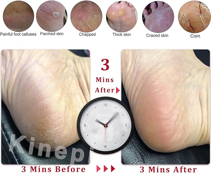 Feet Callus Removers Professional Colossal Foot Scrubber Pedicure Foot File Foot Massager Pumice Stone for Feet,Remover Corn Hard Skin Dead Skin Exfoliator for Use in Shower Feet Care Tools