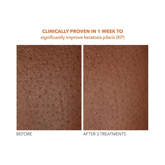 Dr. Dennis Gross Alpha Beta Exfoliating Body Treatment | Multi-Tasking Powered by AHA/BHAs for Smooth, Hydrated Skin While Improving Ingrown Hairs, Keratosis Pilaris, and Blemishes | 2 Textured Towels