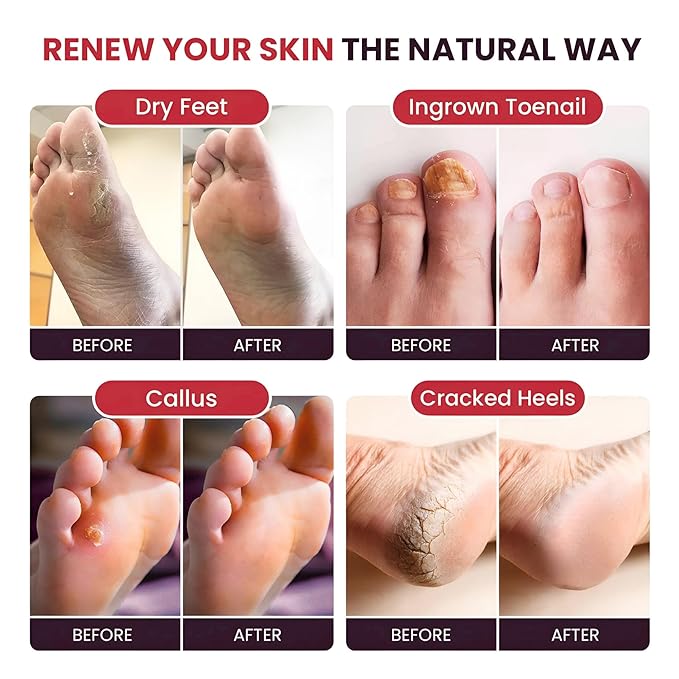 FOOT CURE Tea Tree Oil & Muscle Foot Soak with Epsom Salts - All-Natural Salts for Post-Workout Recovery - Softens Calluses, Soothes Sore & Tired Feet, Foot Odor Control, Spa Pedicure (Pack of 2)