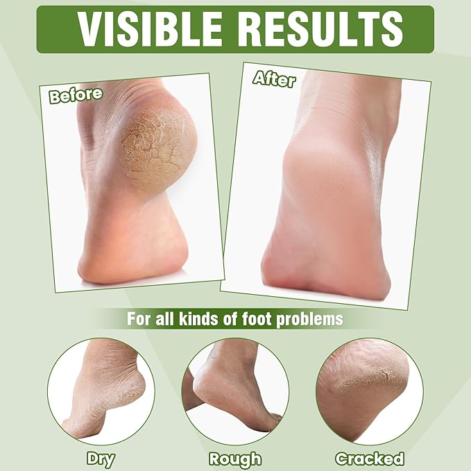 6 Pairs Moisturizing Foot Masks with Shea Butter, Jojoba Oil, Vitamin E & Urea, 6 Pairs Intensely Hydrating Foot Mask For Dry Cracked Feet, Moisturizing Socks for Cracked Heel Treatment