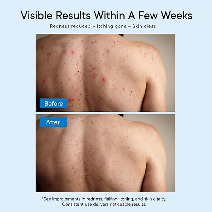 Antifungal Body Wash Treatment Soap – Antibacterial Wash for Jock Itch, Ringworm, Back Acne, Tinea & Foot Odor – Medicated Skin Relief Cleanser Gel with Tea Tree Oil & Tolnaftate for Men and Women