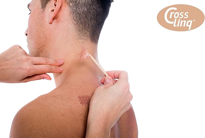 CureTape CrossLinq Acupressure Patches | Acupuncture Patch for Scars & Muscle Pain | Crosshatch Pain Patches | Non-Elastic Crosspatches | Medium | (Pack of 160)