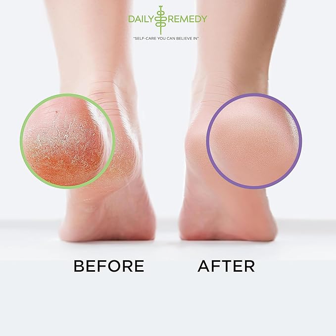 DAILY REMEDY EXTRA STRENGTH Tea Tree Oil & Calming Lavender Foot Soak Set - Made in USA - Soothes Sore Tired Feet, Athletes Foot, Stubborn Foot Odor, and Softens Calluses - Pack of 2