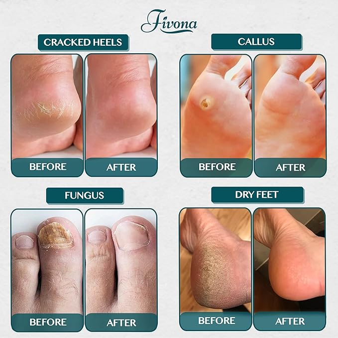 Fivona Tea Tree Foot Soak Blend 14.1 oz - Epsom Salt with Essential Oils for Healthy Toenails, Soothing Relief, Callus Softening - Pedicure Therapy for Soft, Rejuvenated Feet